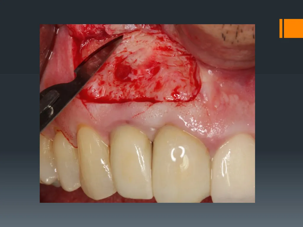 Principles of, incisions Flaps & Suturing - slide 14 of 58
