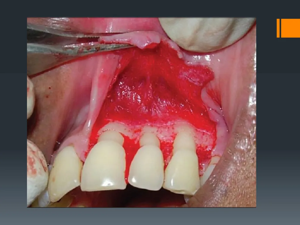 Principles of, incisions Flaps & Suturing - slide 15 of 58