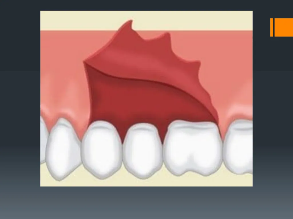 Principles of, incisions Flaps & Suturing - slide 20 of 58