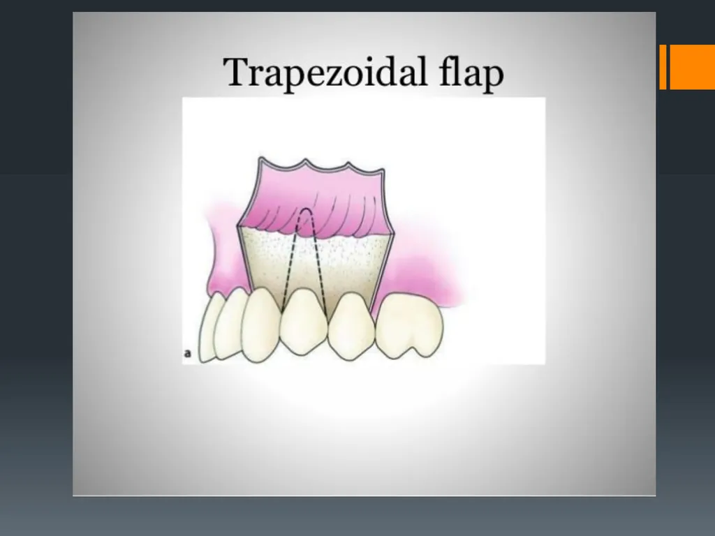 Principles of, incisions Flaps & Suturing - slide 23 of 58