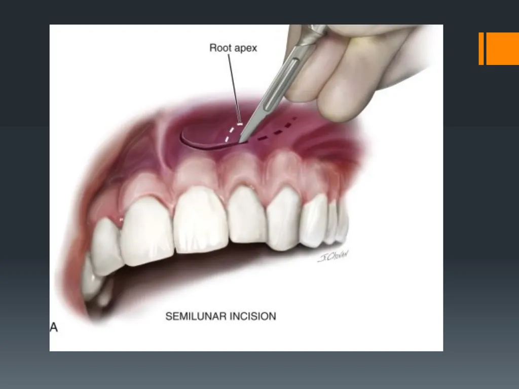 Principles of, incisions Flaps & Suturing - slide 25 of 58