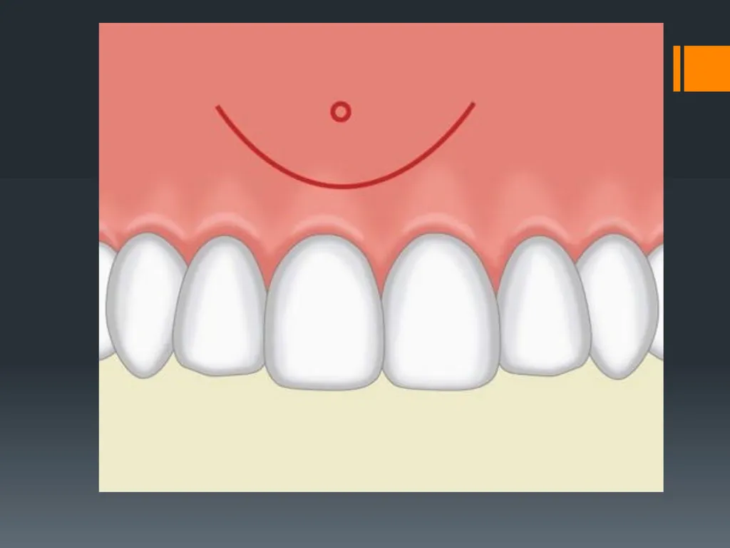 Principles of, incisions Flaps & Suturing - slide 26 of 58