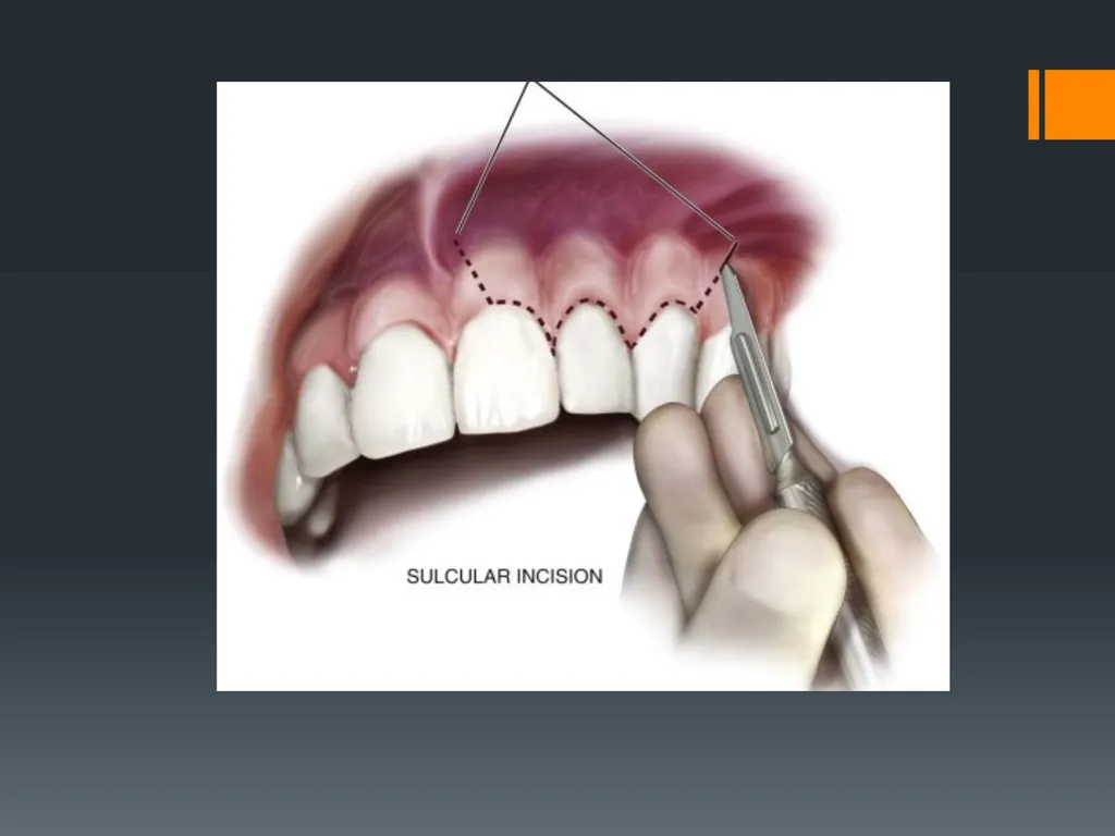 Principles of, incisions Flaps & Suturing - slide 6 of 58