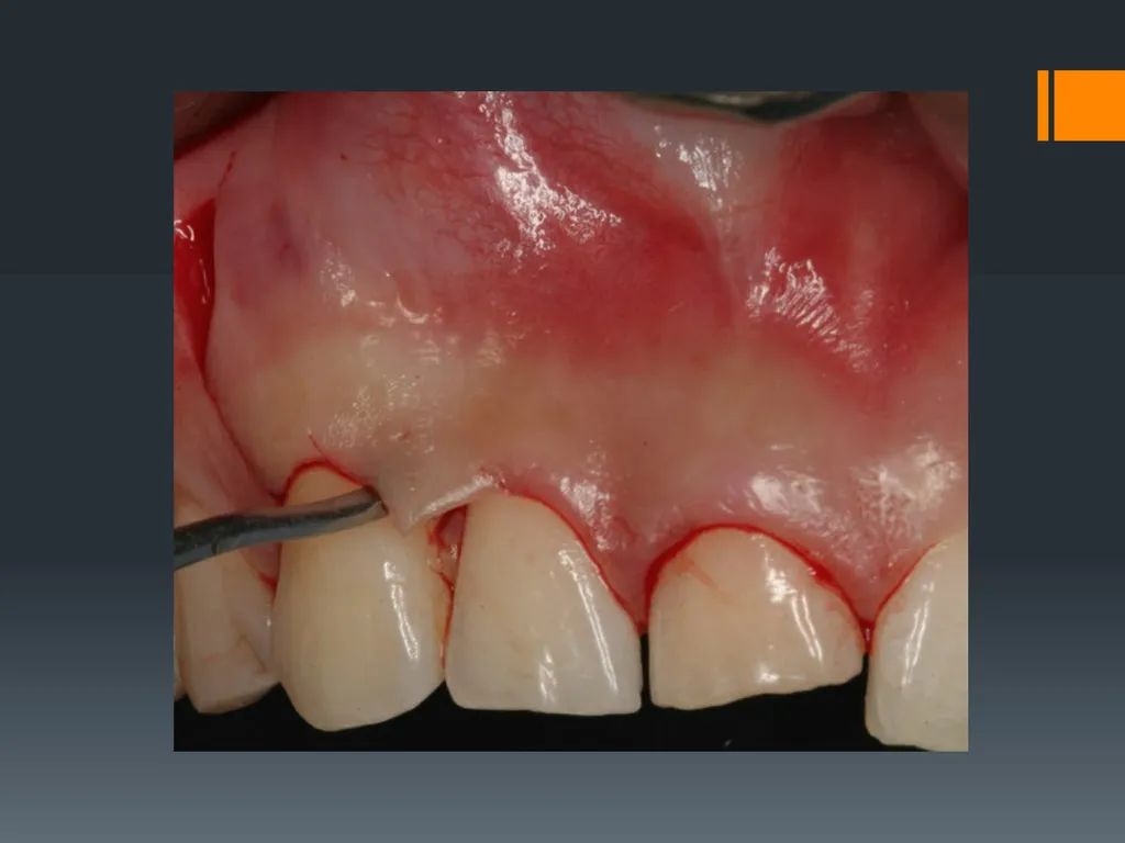 Principles of, incisions Flaps & Suturing - slide 7 of 58