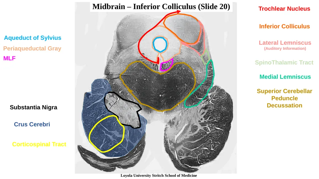 Neuroanatomy Brainstem Slides Self Assessment Use - slide 11 of 13