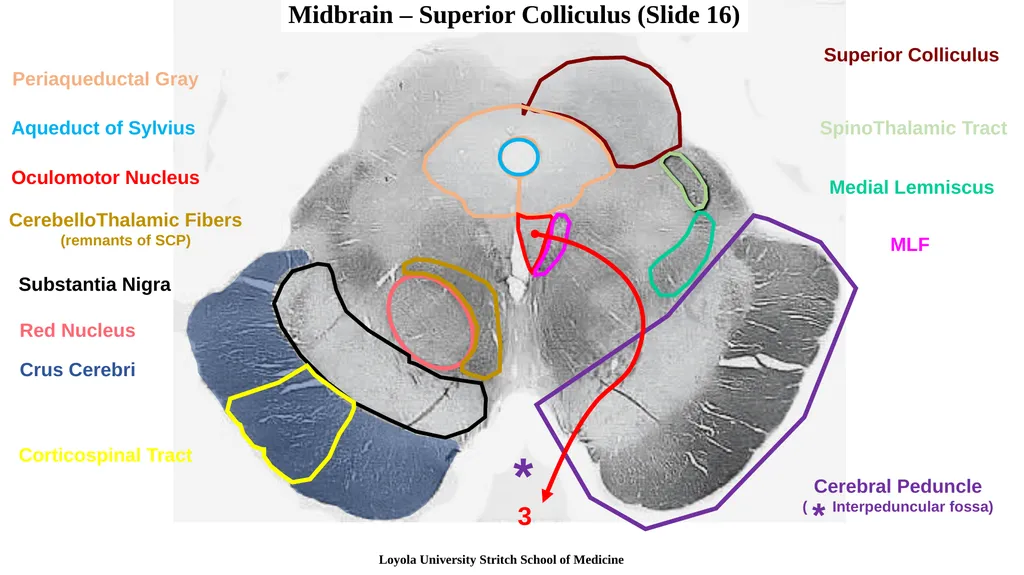 Neuroanatomy Brainstem Slides Self Assessment Use - slide 13 of 13