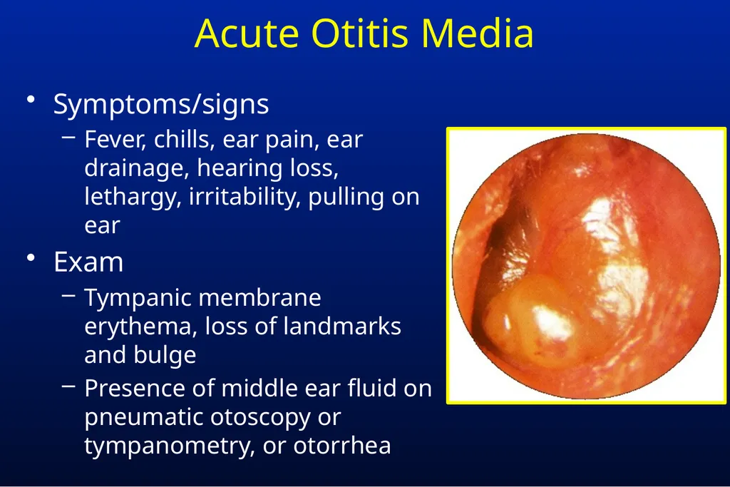 Common Respiratory Tract Infections: Evaluation - slide 38 of 44
