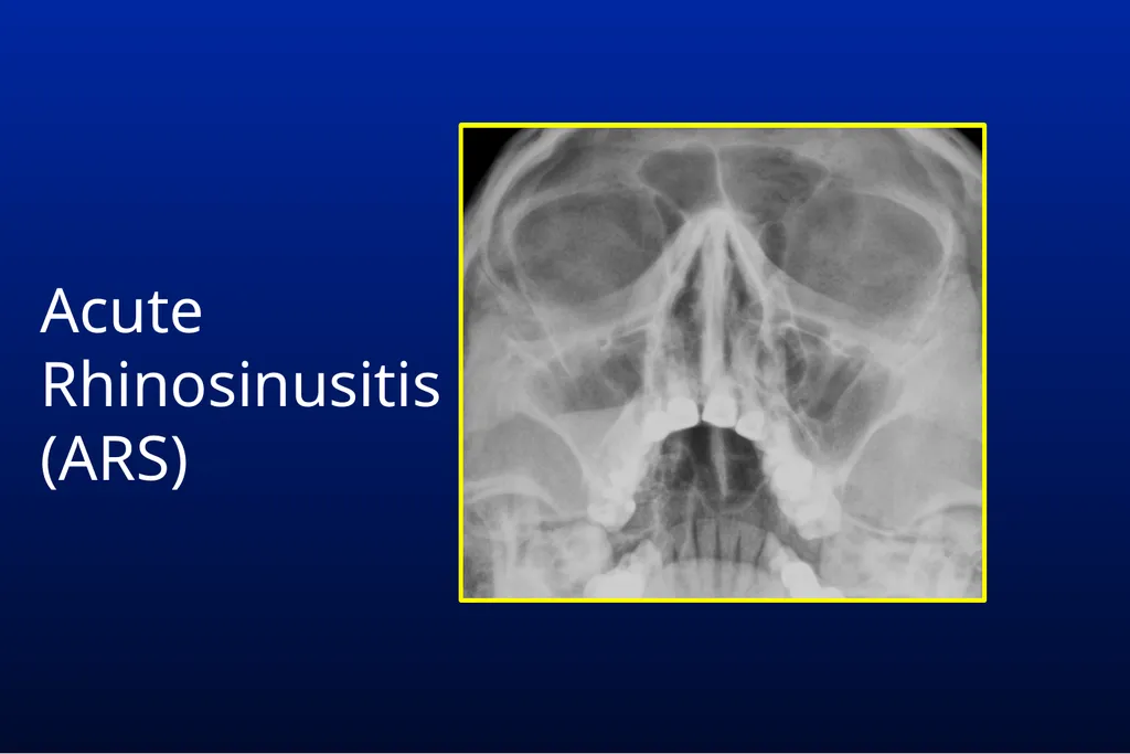 Common Respiratory Tract Infections: Evaluation - slide 25 of 44
