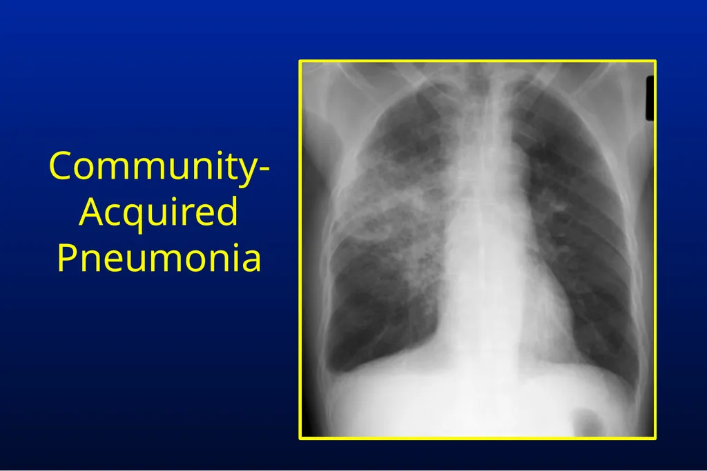 Common Respiratory Tract Infections: Evaluation - slide 12 of 44