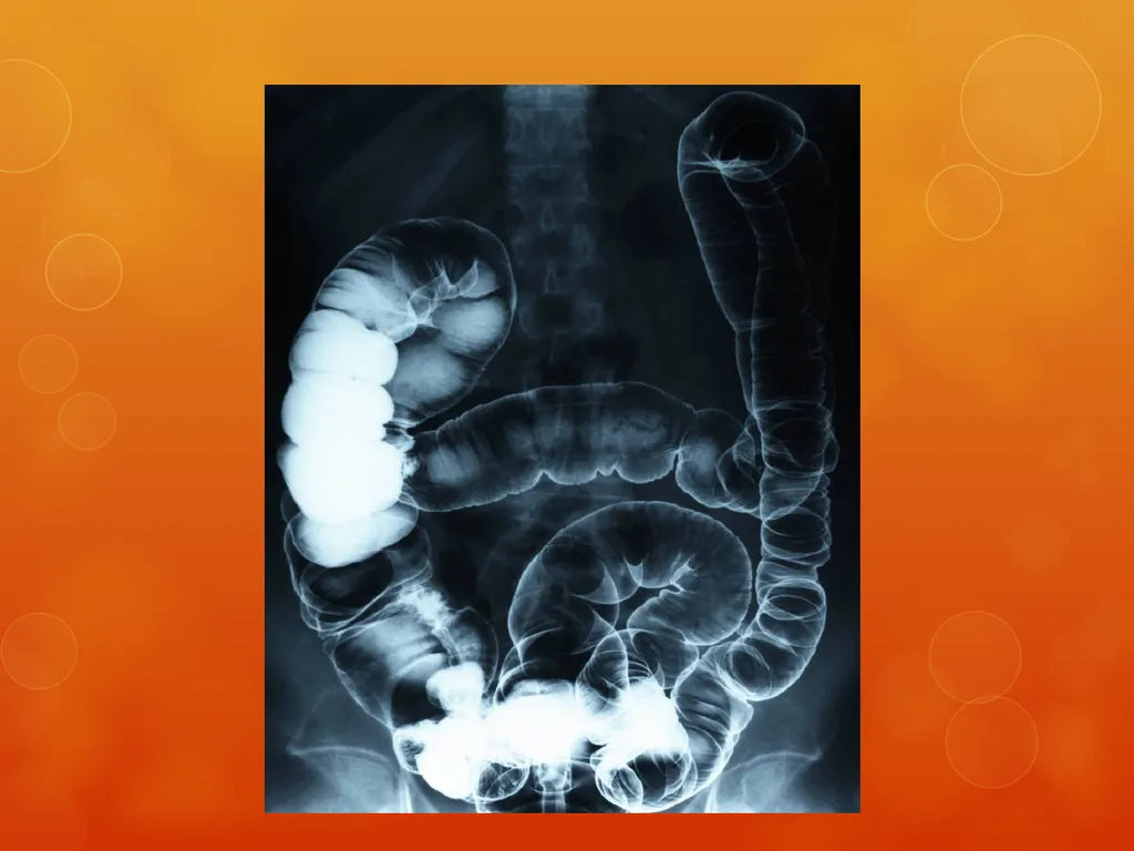 Multiple Primary and Histology Coding Rules Colon - slide 19 of 64