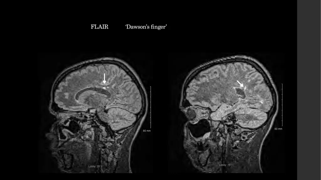 Simultaneous Stroke and first presentation of - slide 6 of 10
