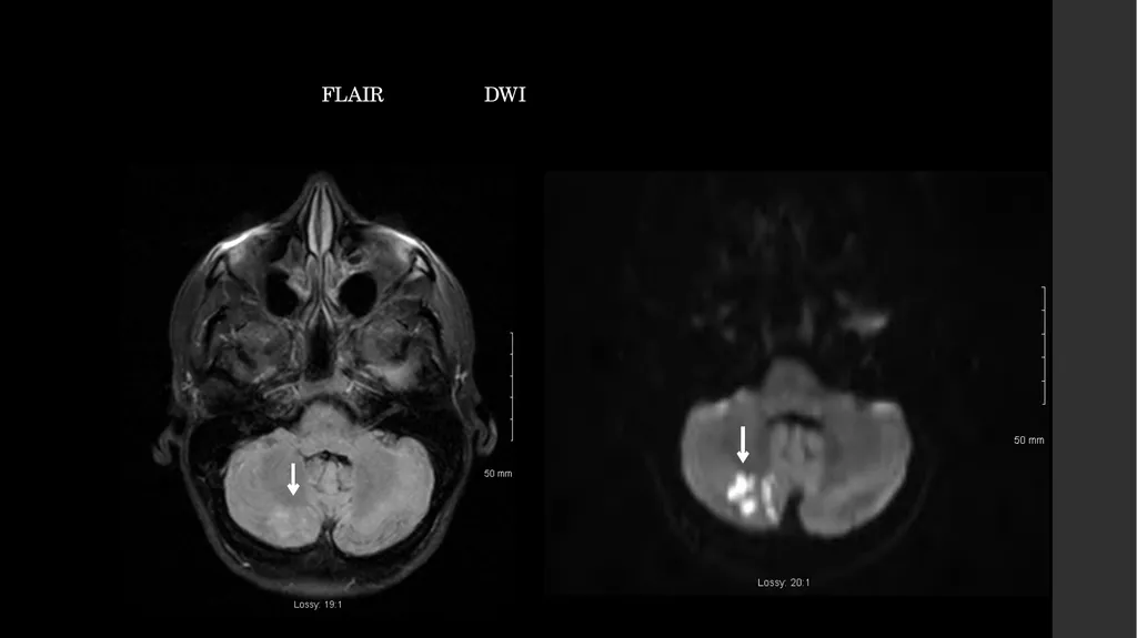 Simultaneous Stroke and first presentation of - slide 8 of 10