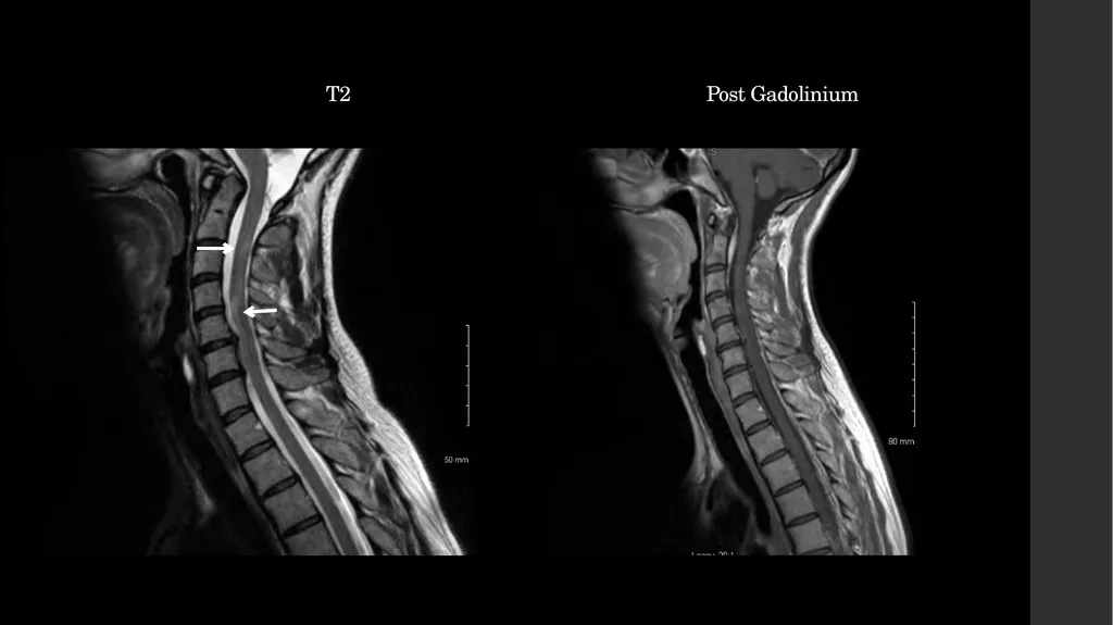 Simultaneous Stroke and first presentation of - slide 7 of 10