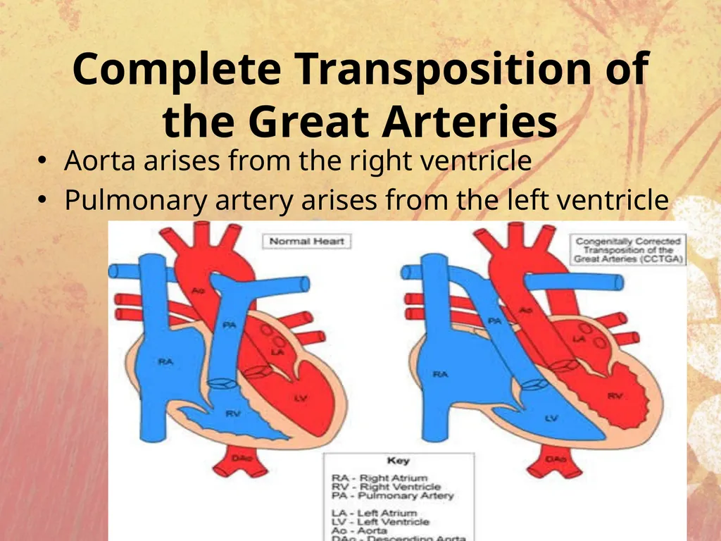 Cyanotic congenital heart disease BY MBBSPPT.COM - slide 28 of 41