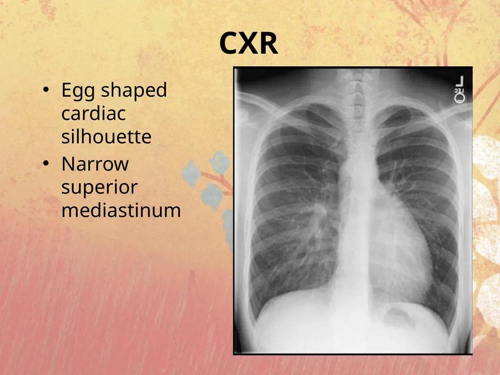 Cyanotic congenital heart disease BY MBBSPPT.COM - slide 32 of 41