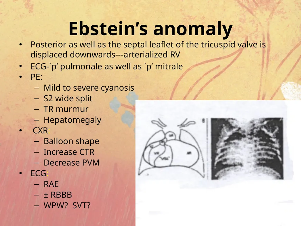 Cyanotic congenital heart disease BY MBBSPPT.COM - slide 25 of 41