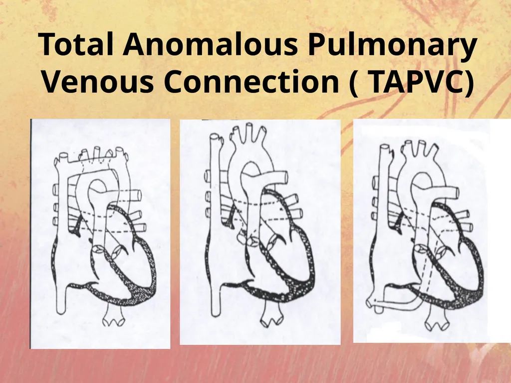 Cyanotic congenital heart disease BY MBBSPPT.COM - slide 34 of 41