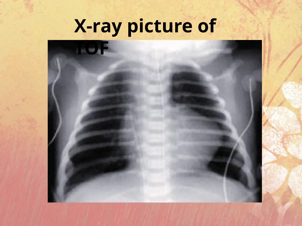 Cyanotic congenital heart disease BY MBBSPPT.COM - slide 16 of 41