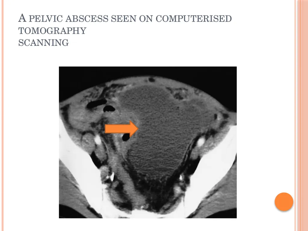 Abdominal and pelvic abscesses Abscess formation - slide 5 of 31