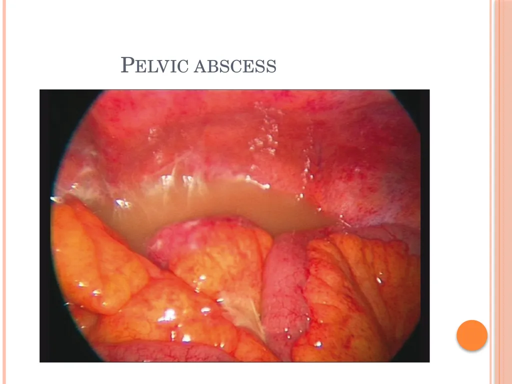 Abdominal and pelvic abscesses Abscess formation - slide 7 of 31