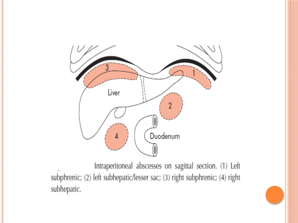 Abdominal and pelvic abscesses Abscess formation - slide 10 of 31