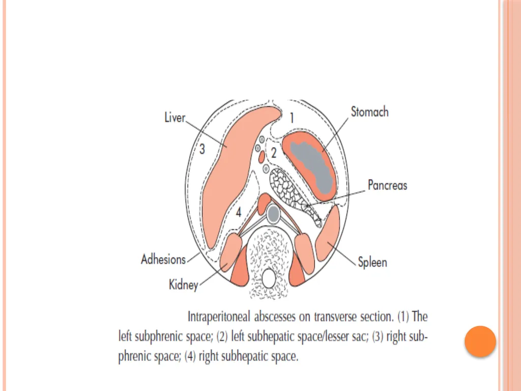 Abdominal and pelvic abscesses Abscess formation - slide 12 of 31