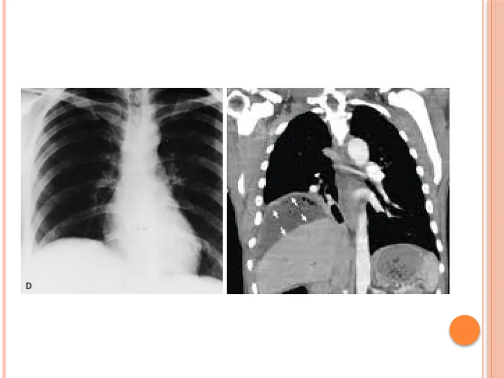 Abdominal and pelvic abscesses Abscess formation - slide 17 of 31