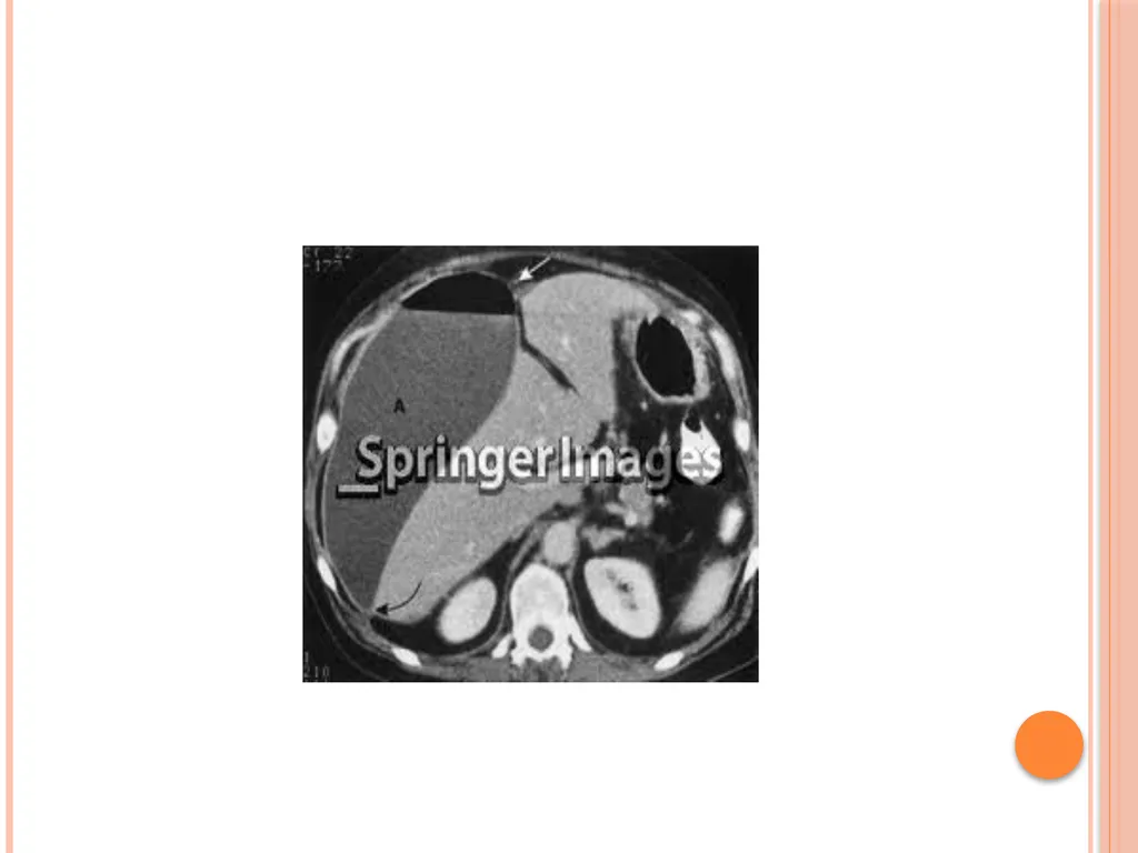 Abdominal and pelvic abscesses Abscess formation - slide 18 of 31