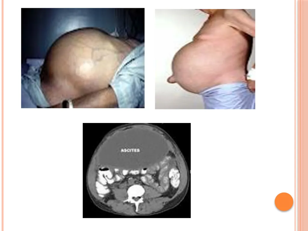 Abdominal and pelvic abscesses Abscess formation - slide 28 of 31