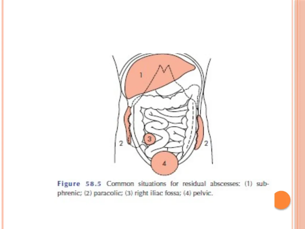 Abdominal and pelvic abscesses Abscess formation - slide 3 of 31