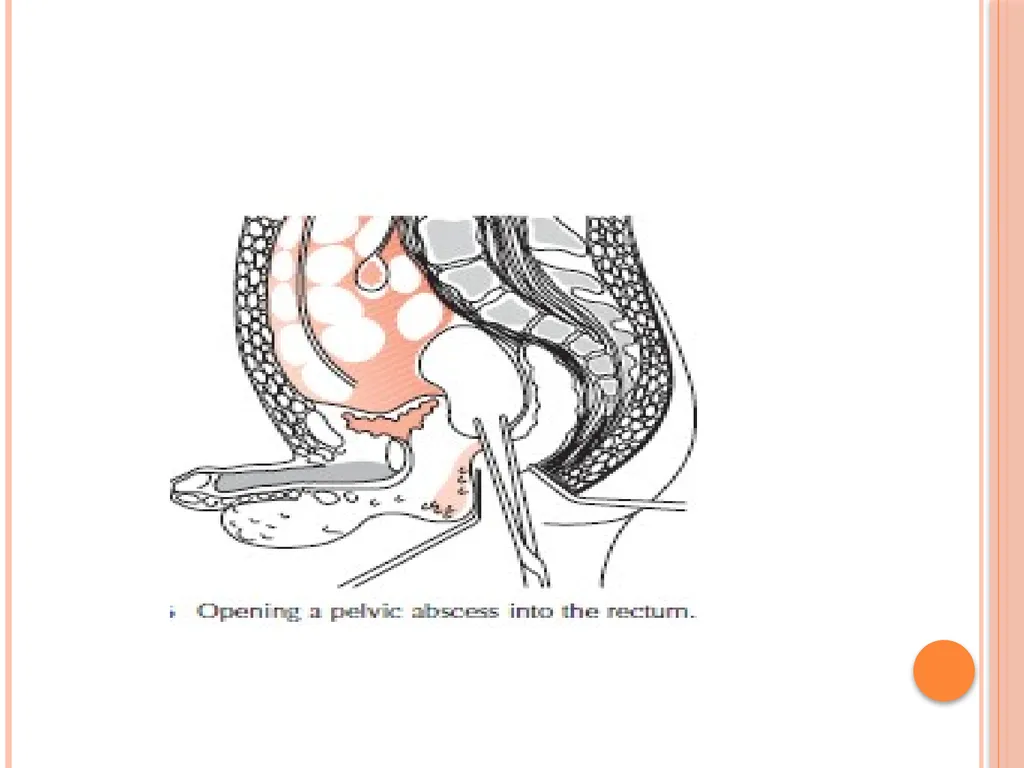 Abdominal and pelvic abscesses Abscess formation - slide 8 of 31
