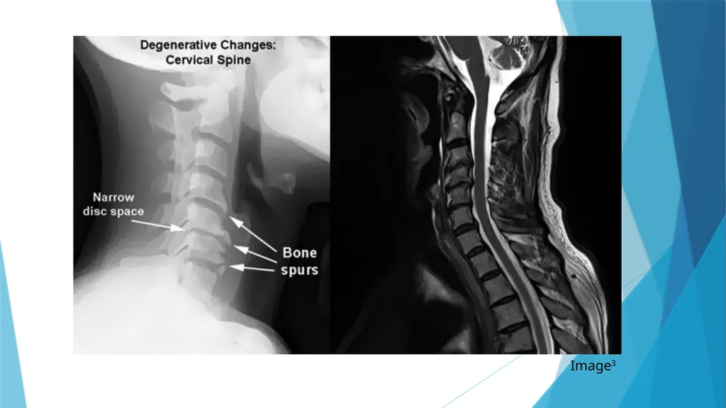 Cervical Spondylosis: A Case Study Leslie Rainey - slide 3 of 18