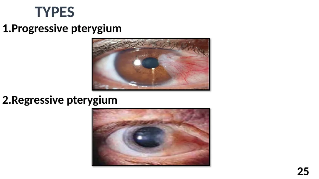 अर्म Dr Adeeb A ASST PROFESSOR Shalakyatantra - slide 25 of 33