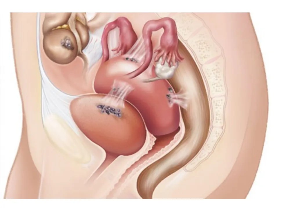 Endometriosis Dr Fulufhelo Tshivhula Specialist - slide 14 of 71