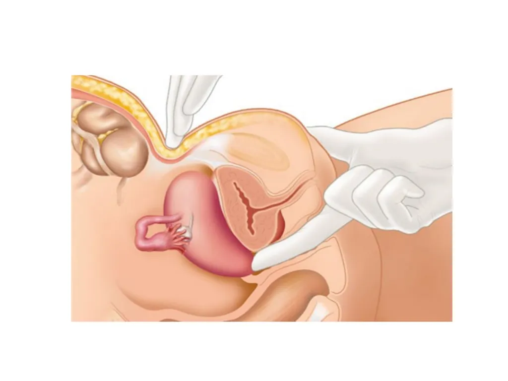 Endometriosis Dr Fulufhelo Tshivhula Specialist - slide 31 of 71