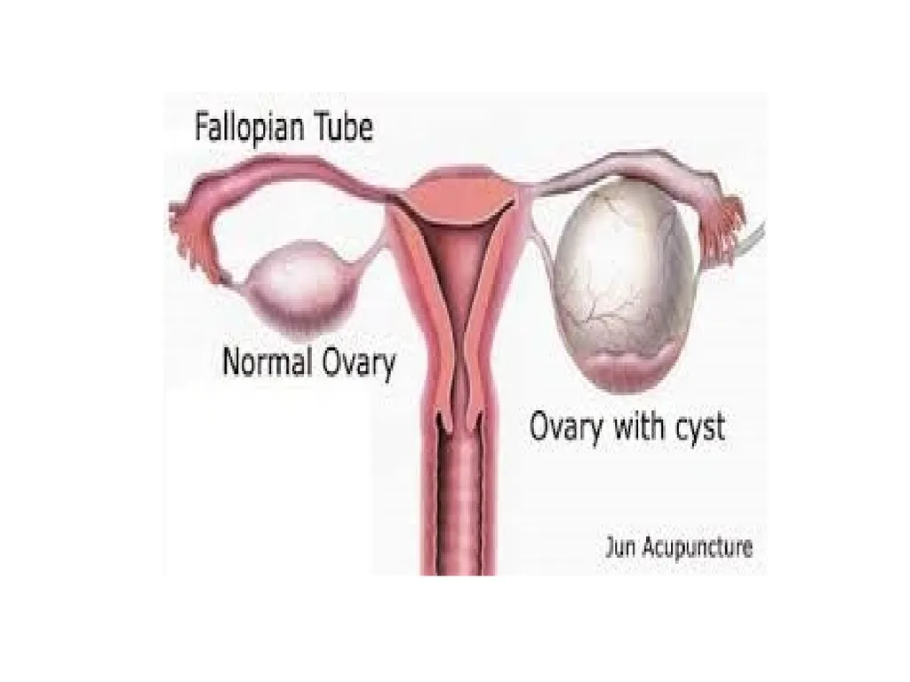 Endometriosis Dr Fulufhelo Tshivhula Specialist - slide 35 of 71