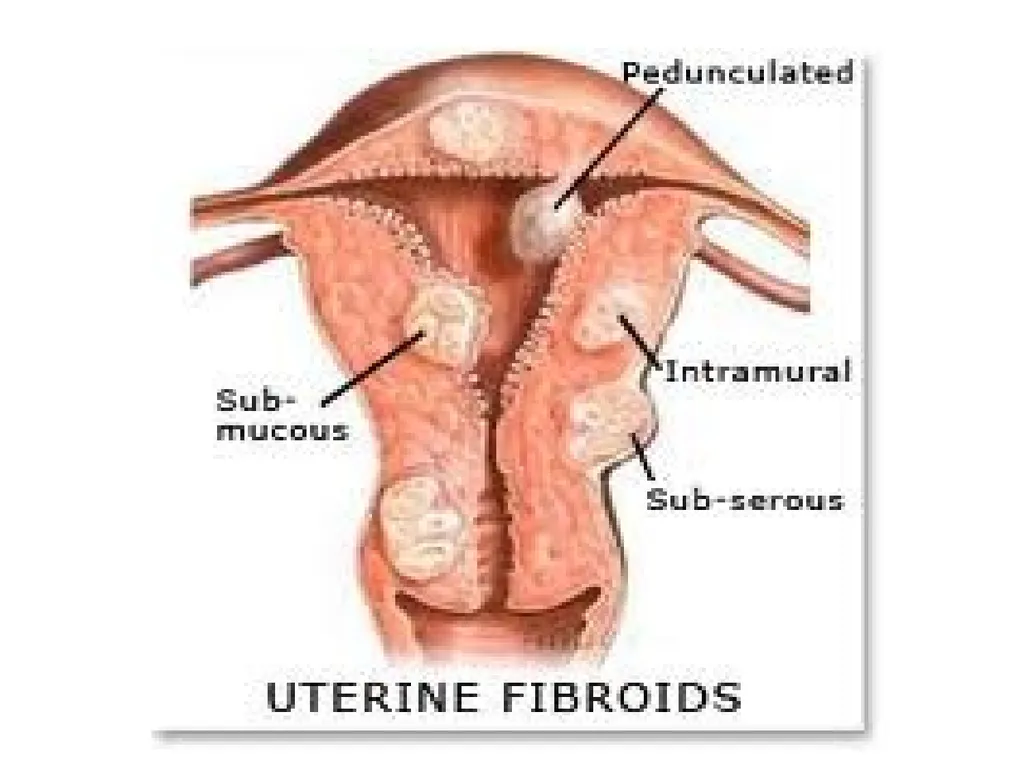 Endometriosis Dr Fulufhelo Tshivhula Specialist - slide 36 of 71