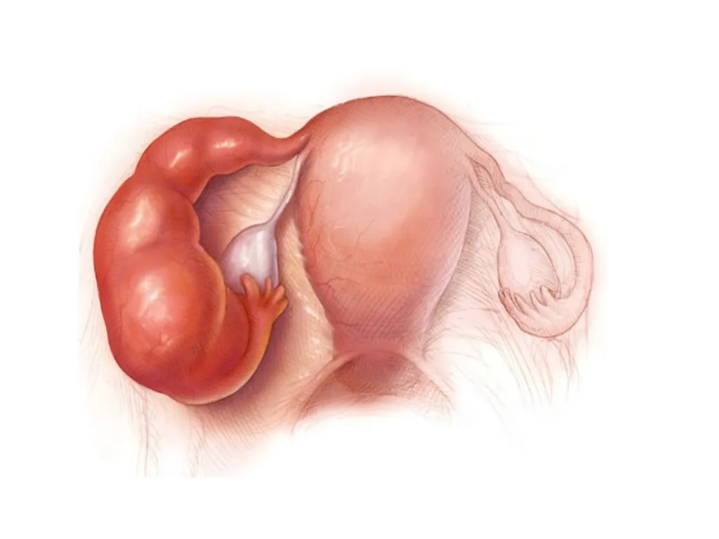 Endometriosis Dr Fulufhelo Tshivhula Specialist - slide 37 of 71