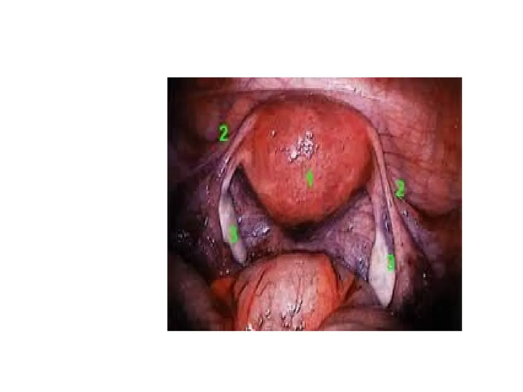 Endometriosis Dr Fulufhelo Tshivhula Specialist - slide 40 of 71