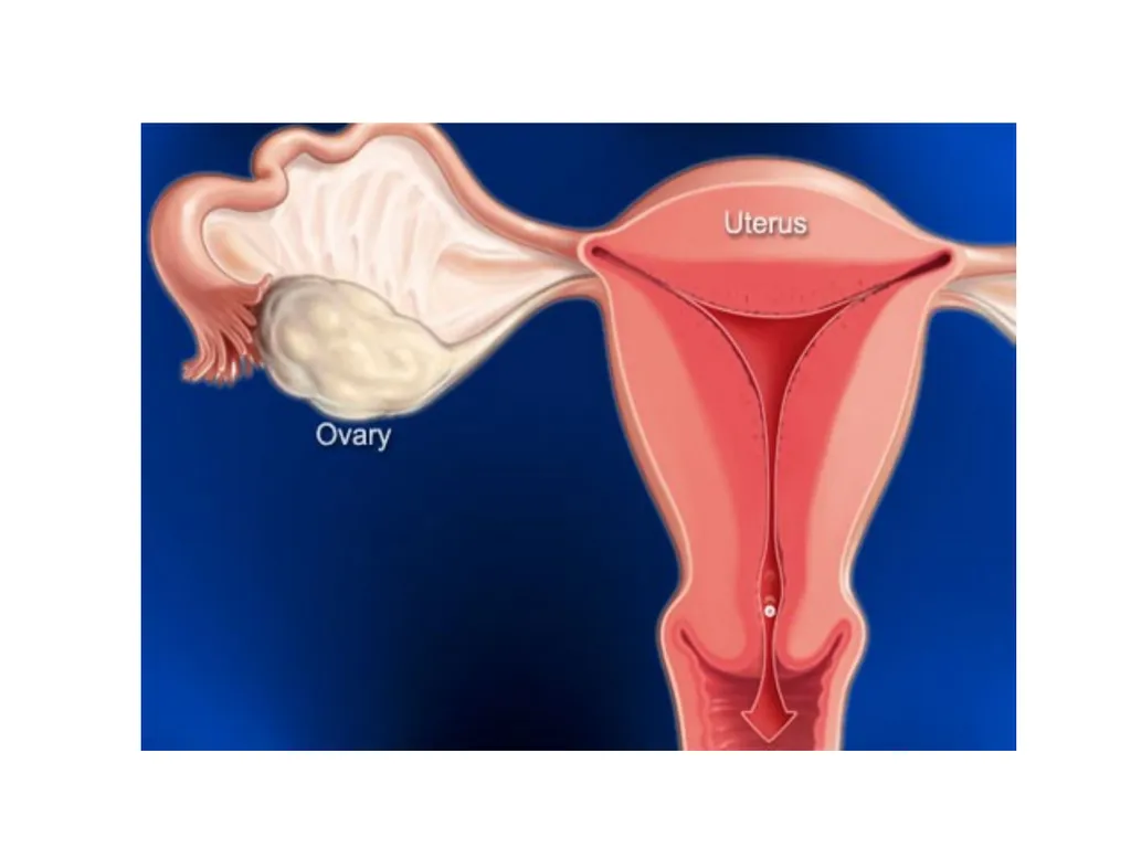 Endometriosis Dr Fulufhelo Tshivhula Specialist - slide 6 of 71