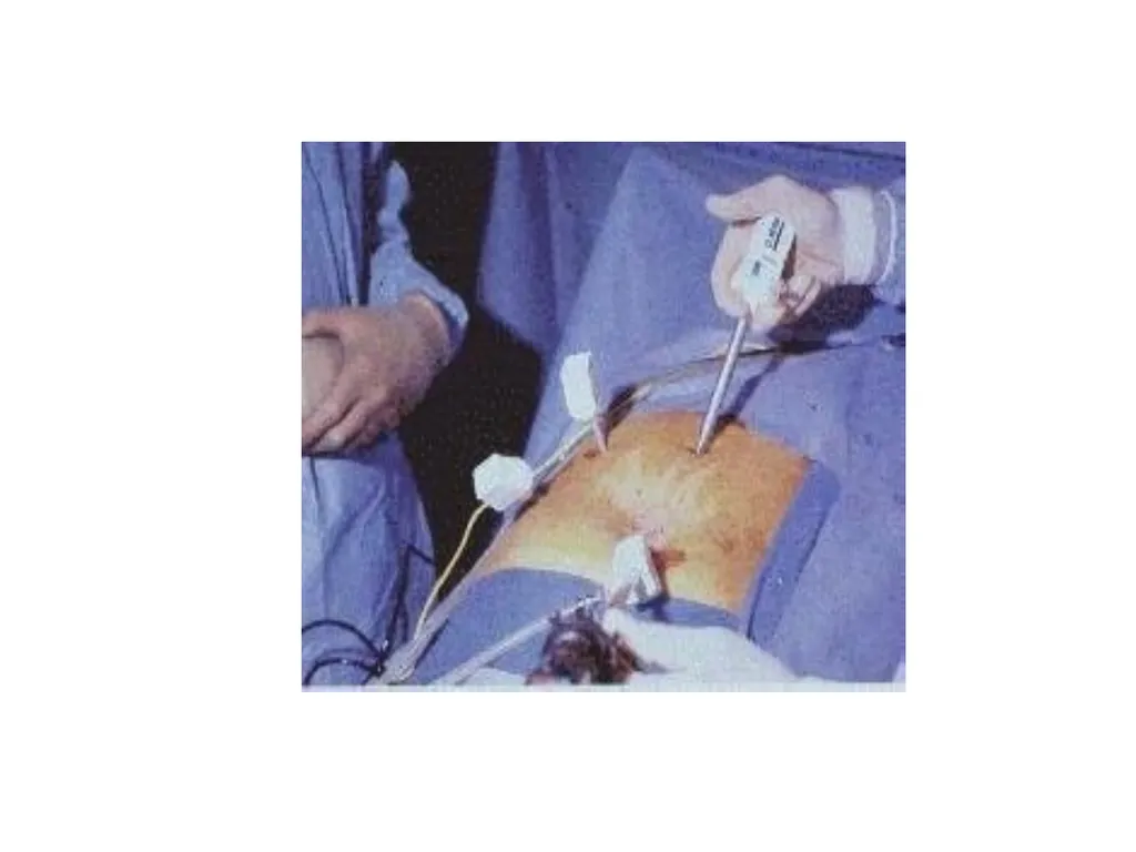 Endometriosis Dr Fulufhelo Tshivhula Specialist - slide 61 of 71