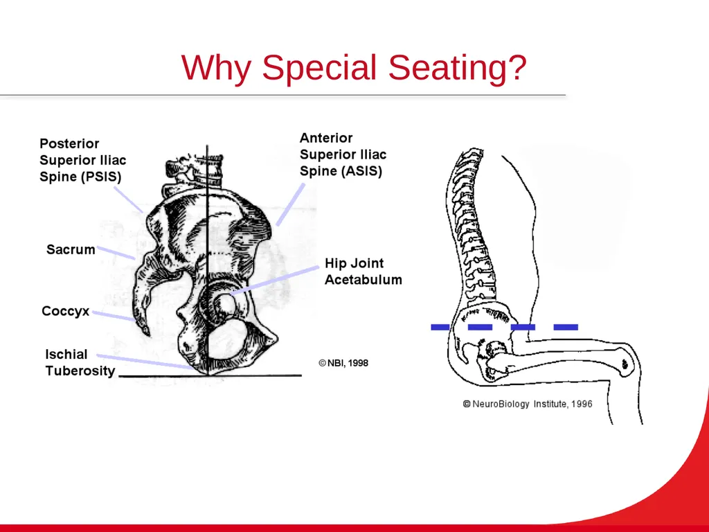 Introduction to Wheelchairs and Seating Spinal - slide 35 of 36
