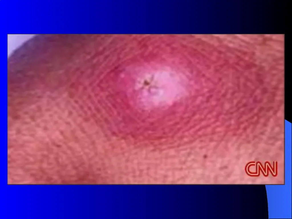 MRSA METHICILLIN-RESISTANT STAPHYLOCOCCUS AUREUS - slide 5 of 11