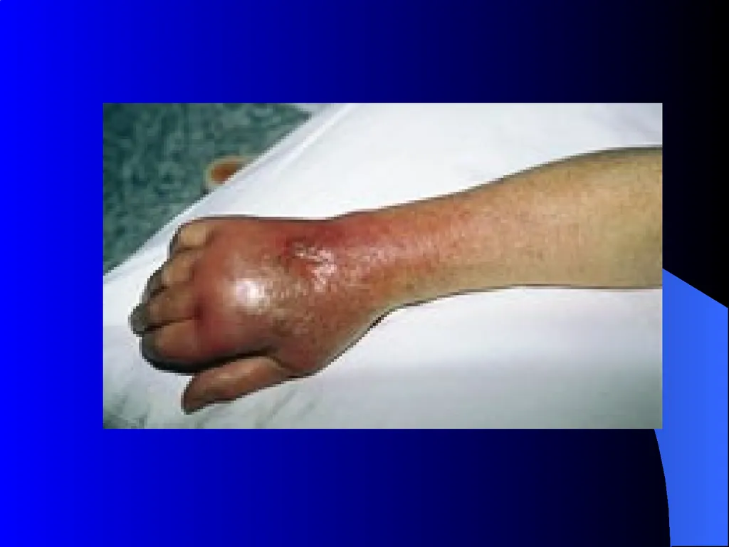 MRSA METHICILLIN-RESISTANT STAPHYLOCOCCUS AUREUS - slide 6 of 11
