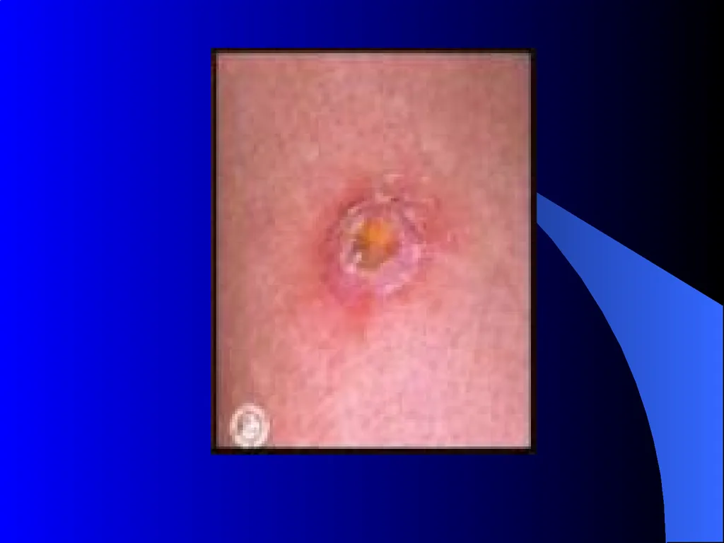 MRSA METHICILLIN-RESISTANT STAPHYLOCOCCUS AUREUS - slide 7 of 11