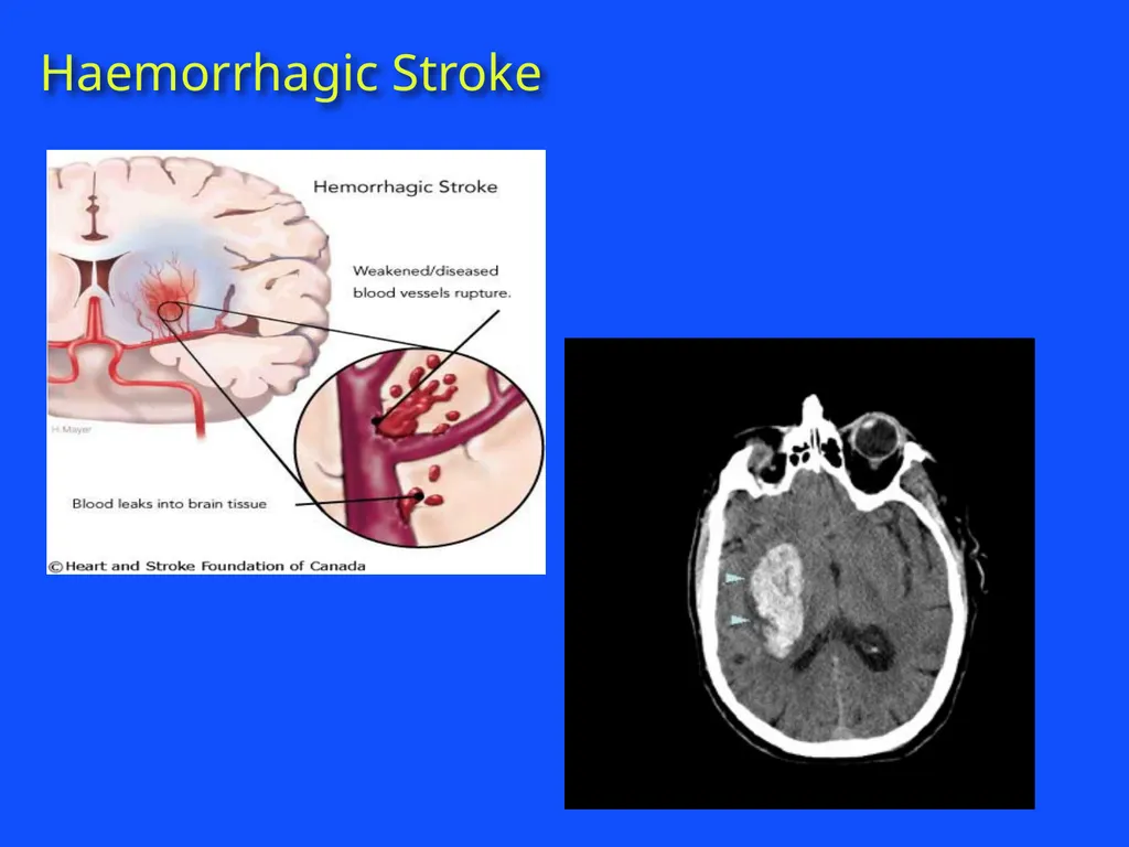 RAPID INTERVENTION WITH GTN IN HYPERACUTE STROKE - slide 5 of 28