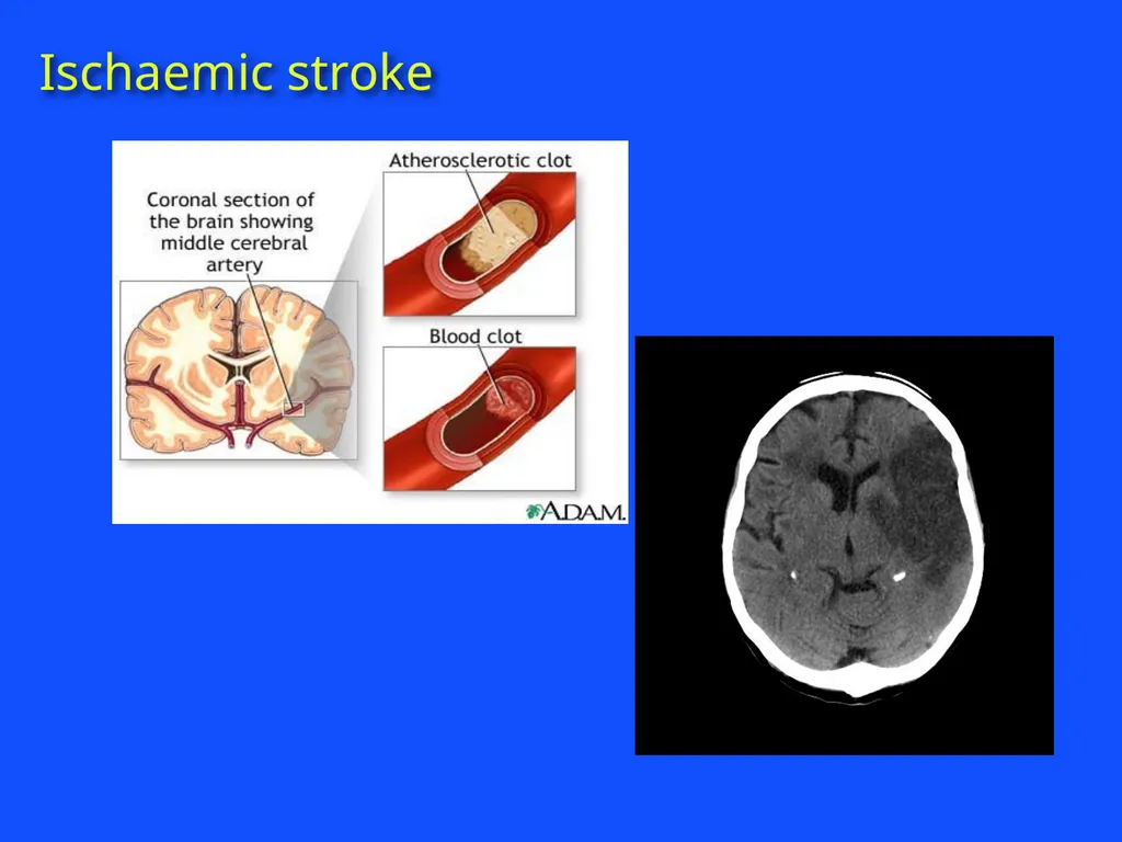RAPID INTERVENTION WITH GTN IN HYPERACUTE STROKE - slide 4 of 28