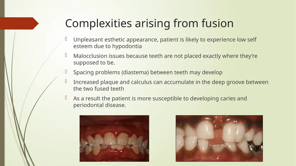 Tooth Fusion By Bushra Meraj Histology & - slide 6 of 9