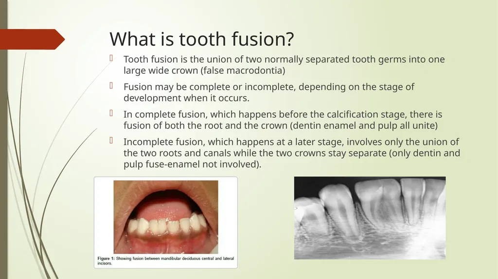 Tooth Fusion By Bushra Meraj Histology & - slide 2 of 9