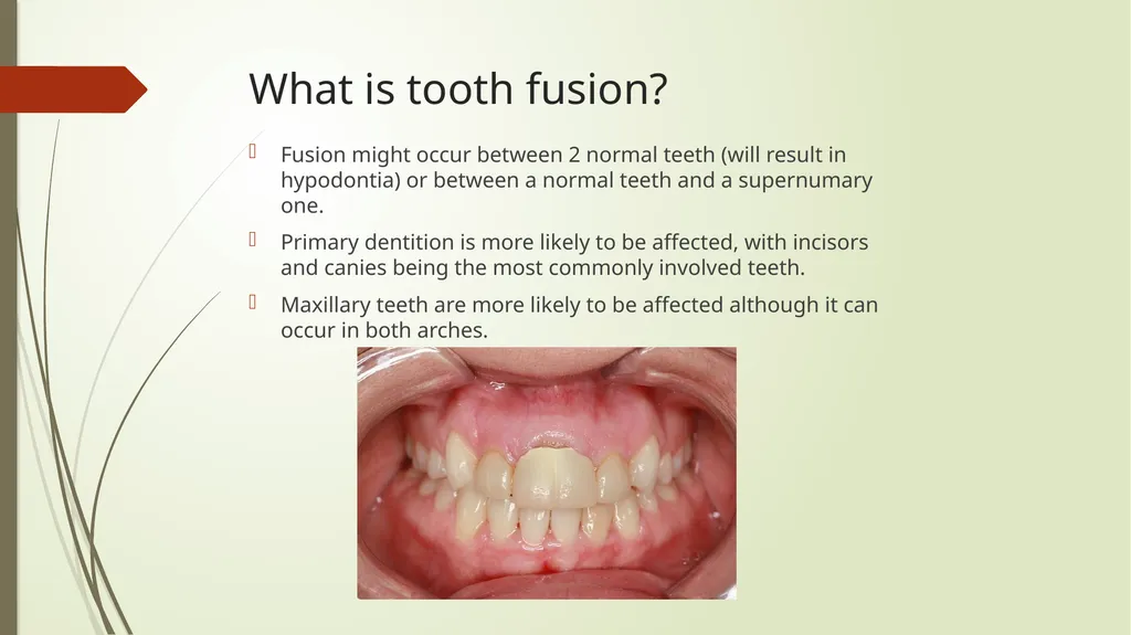 Tooth Fusion By Bushra Meraj Histology & - slide 3 of 9